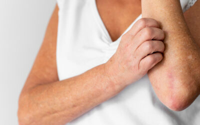 Psoriasis: cómo evitar que evolucione hacia artritis psoriásica