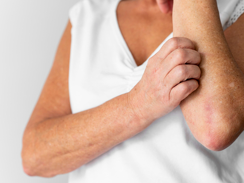 Psoriasis: cómo evitar que evolucione hacia artritis psoriásica Imagen32989D