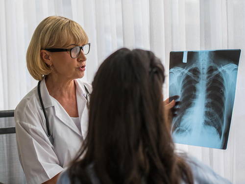 Cáncer de pulmón en mujeres: diferencias respecto a los hombres Imagen33503D