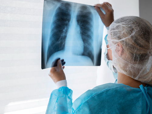 ¿Cómo afecta la neumonía en el cuerpo? Imagen33693D