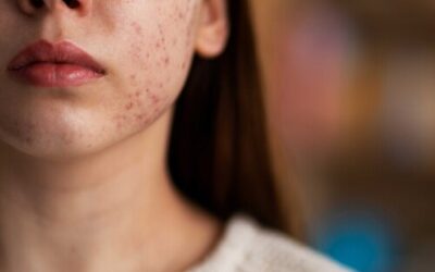 El acné no es cosa sólo de adolescentes, cada vez más adultos lo sufren: causas y consejos