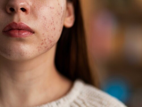El acné no es cosa sólo de adolescentes, cada vez más adultos lo sufren: causas y consejos Imagen34218D