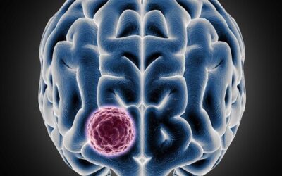 El glioma de bajo grado: todo lo que debes saber sobre este tumor cerebral que afecta principalmente a jóvenes
