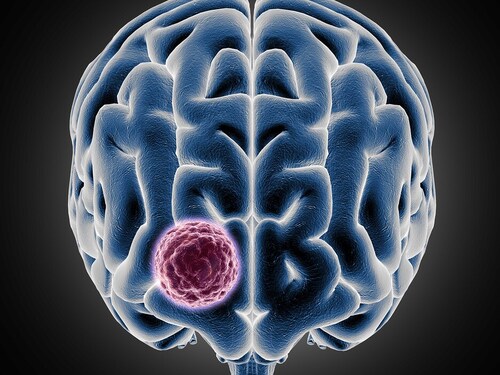 El glioma de bajo grado: todo lo que debes saber sobre este tumor cerebral que afecta principalmente a jóvenes Imagen34280D