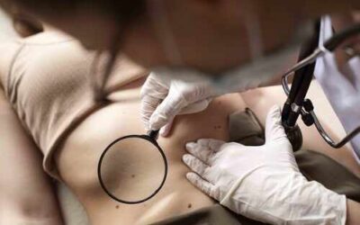 Carcinoma y melanoma: las diferencias de dos tipos de cáncer de piel