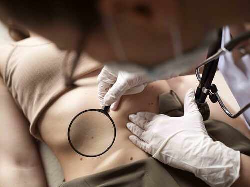 Carcinoma y melanoma: las diferencias de dos tipos de cáncer de piel Imagen34321D