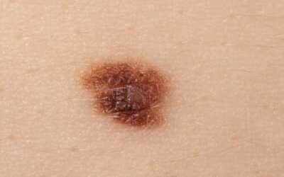 Cáncer de piel: así son los lunares, las manchas o las heridas que pueden ser signo de un tumor