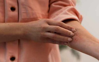 Dermatitis atópica en verano: por qué muchos pacientes notan una mejoría cuando llega el calor