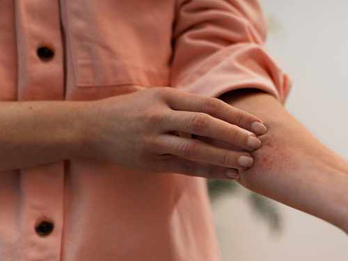 Dermatitis atópica en verano: por qué muchos pacientes notan una mejoría cuando llega el calor Imagen34453D