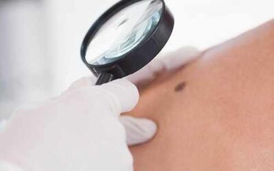 Lunares y manchas: las señales que conviene vigilar para detectar un cáncer de piel