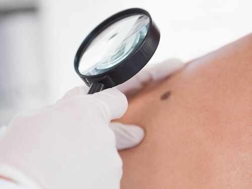 Lunares y manchas: las señales que conviene vigilar para detectar un cáncer de piel Imagen34564D