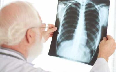 Avance en el cáncer de pulmón: identifican un biomarcador que mejora el diagnóstico y tratamiento