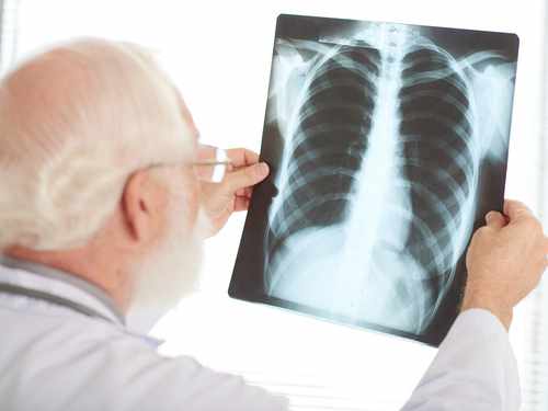 Avance en el cáncer de pulmón: identifican un biomarcador que mejora el diagnóstico y tratamiento Imagen34569D