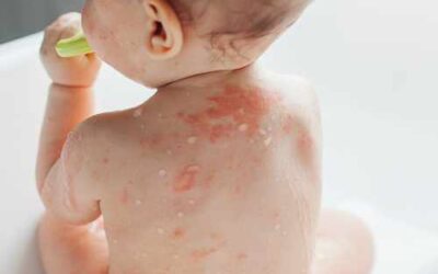 Dermatitis atópica: cómo cuidar la piel antes de que aparezcan los brotes