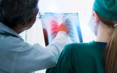 ¿Qué es un nódulo pulmonar? ¿Puede ser maligno? ¿Cómo es la cirugía?